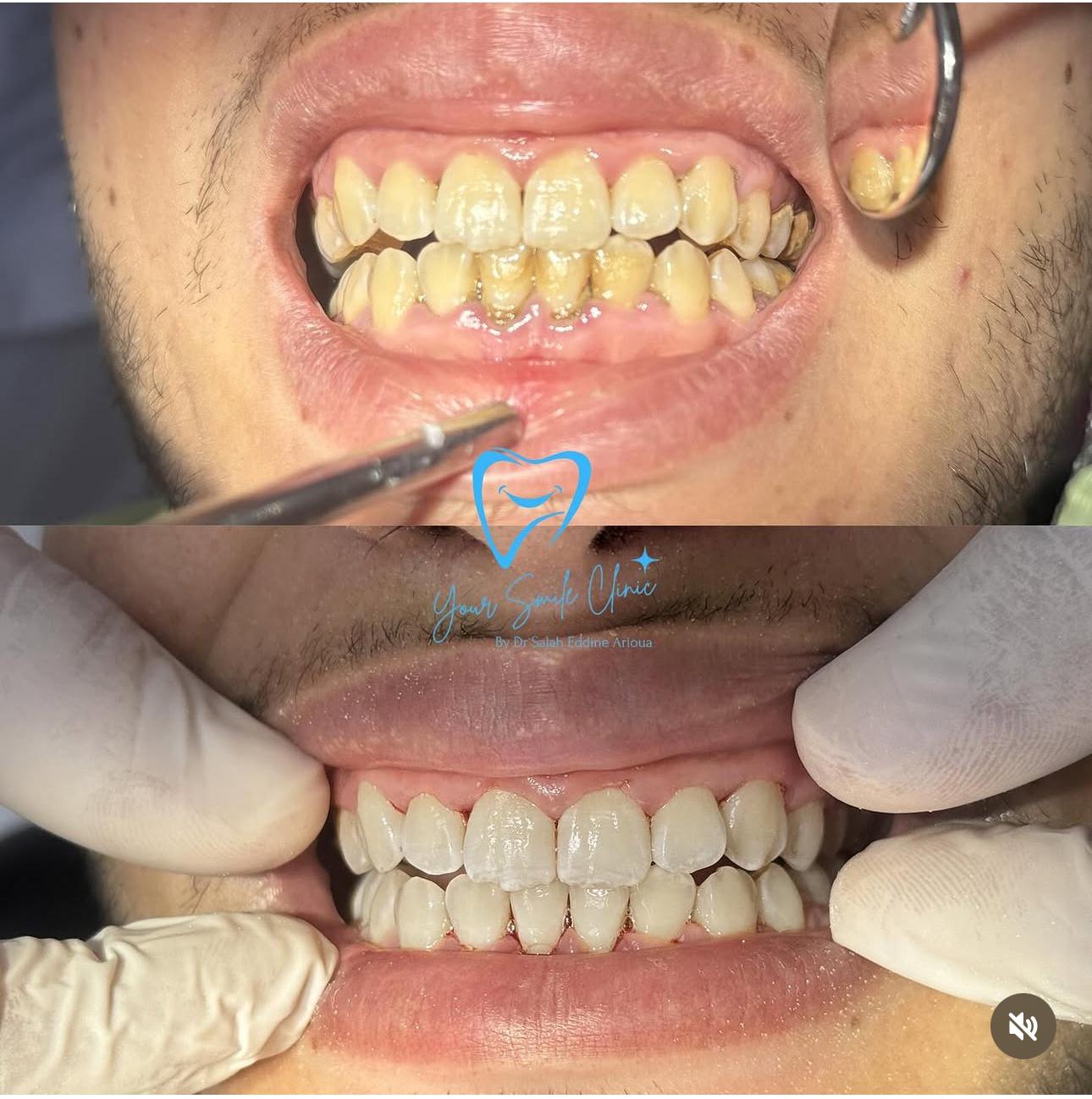 Détartrage professionnel pour prévenir les maladies gingivales