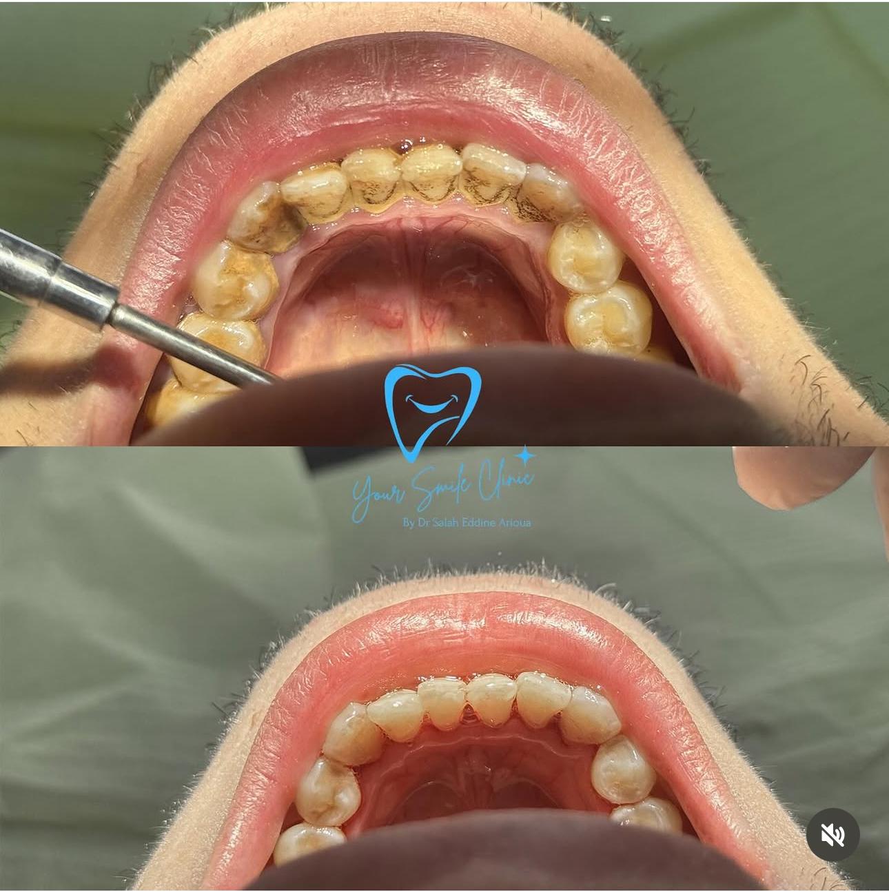 Nettoyage dentaire en profondeur à Your Smile Clinic