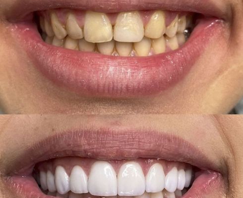 Blanchiment dentaire esthétique à Témara