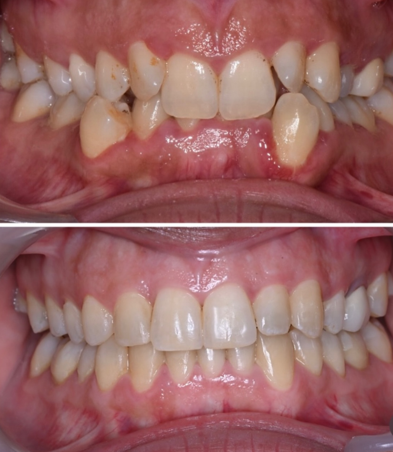 Suivi orthodontique pour alignement progressif des dents