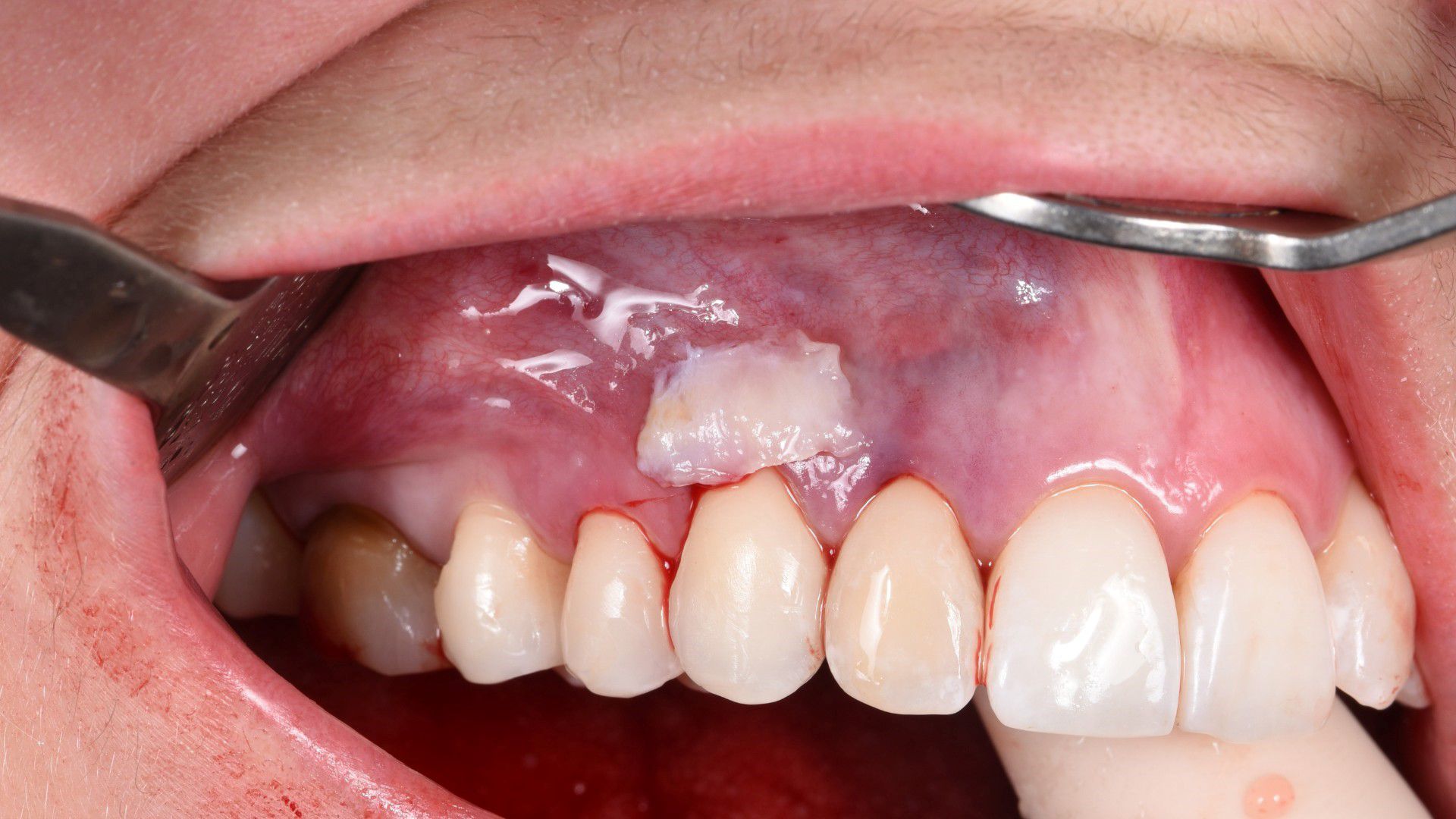 Traitement des gencives en parodontologie